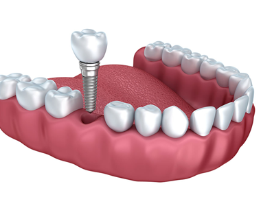 Will Dental Implants really help you? Let’s see what the Clinical results say?- treatment at cheesman dental care  